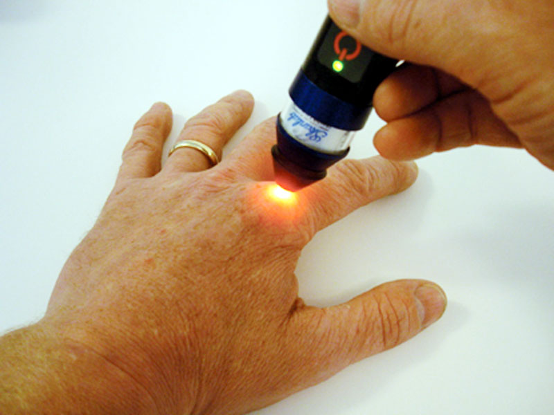 skanlab-laser-behandlungsbeispiel-fingergelenk